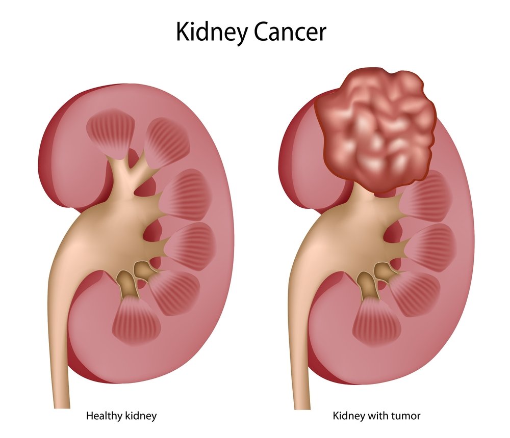 kidney cancer treatment in Delhi